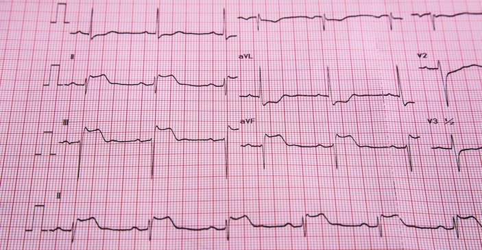 ECG - IAMCEST - signos de elevación del ST e infarto del músculo cardíaco