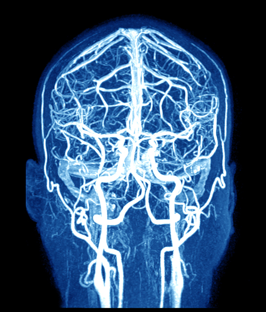 IRM del cerebro y los vasos cerebrales