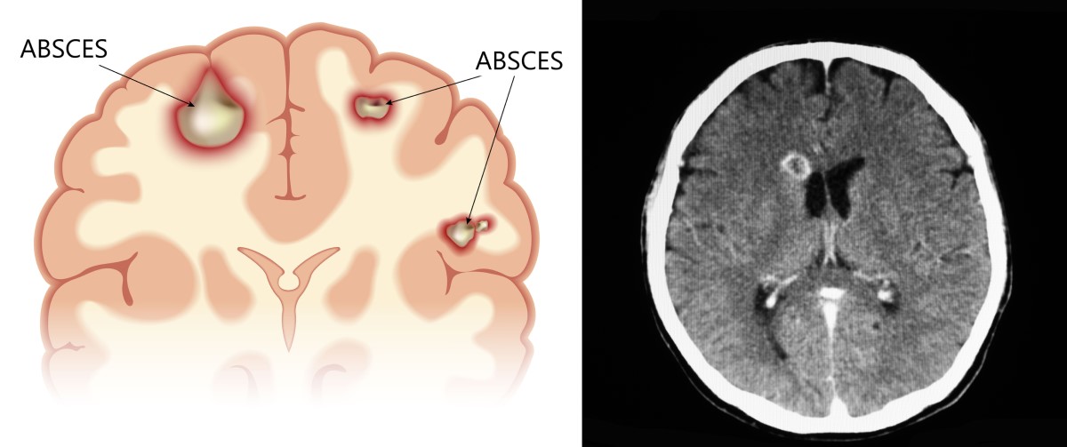 Vistas anatómicas y TC de un absceso cerebral