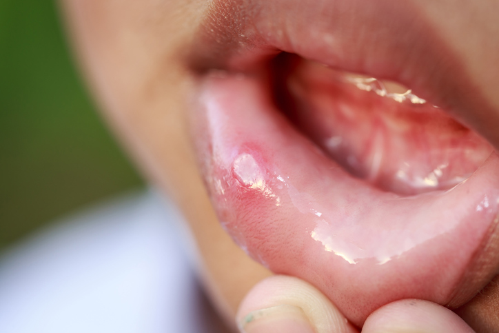 Aphta en el interior de los labios del niño