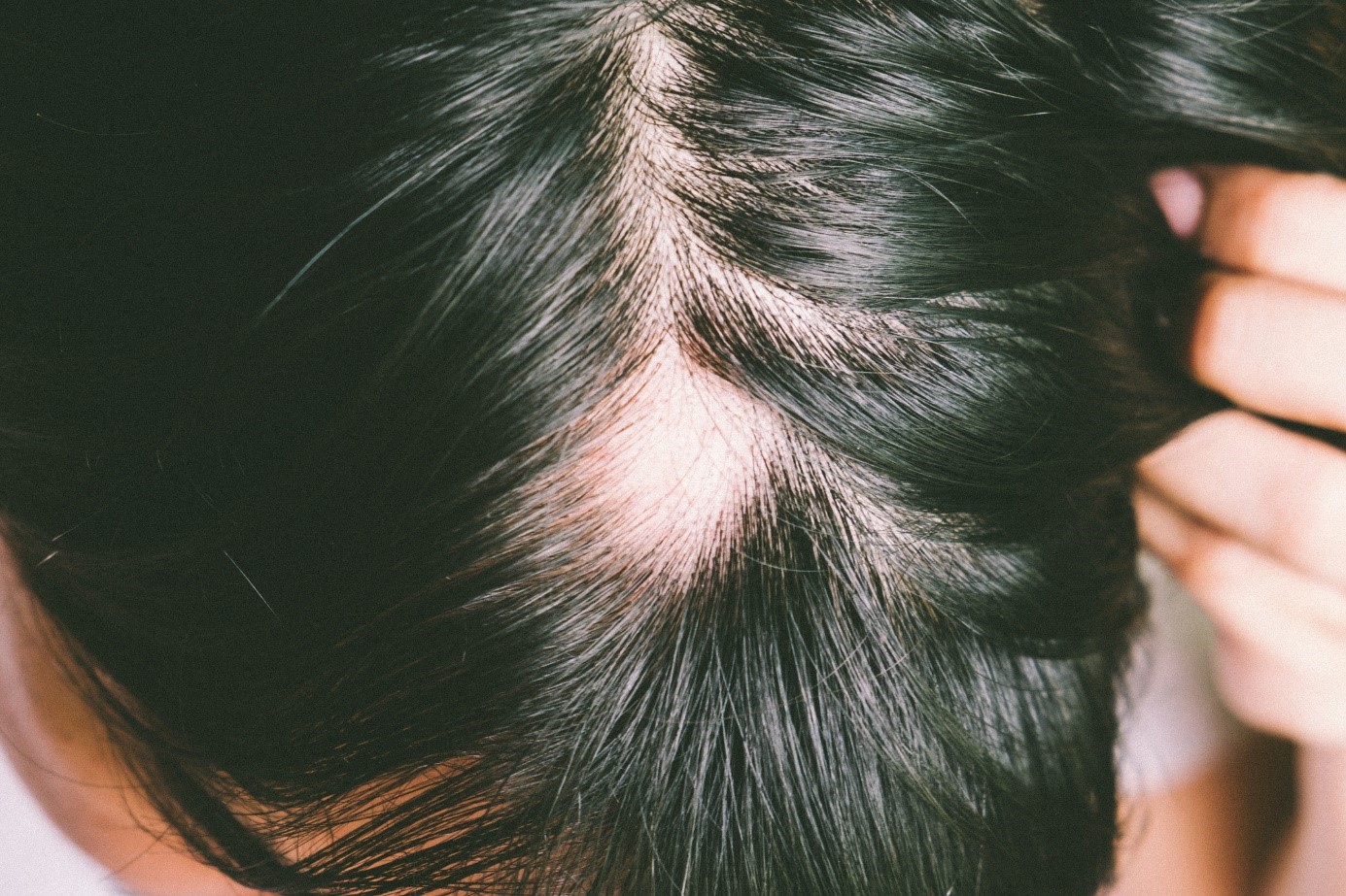 Alopecia, cabeza, pelo negro, condición de caída excesiva del cabello