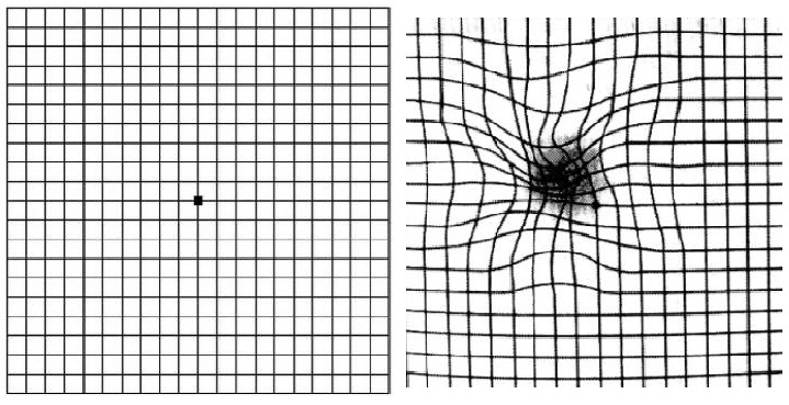 Test de Amsler - cuadrícula en visión normal y a la derecha en degeneración macular