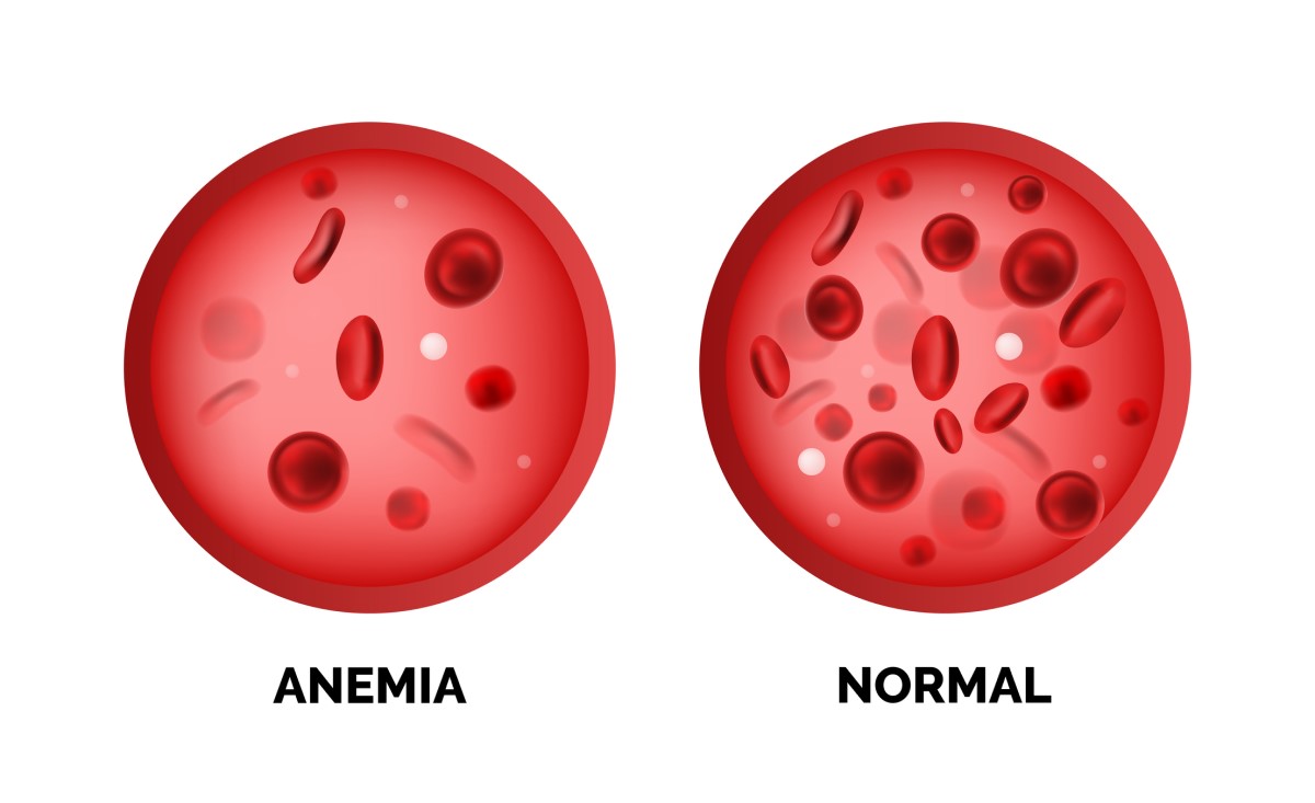 Anemia y niveles normales de glóbulos rojos