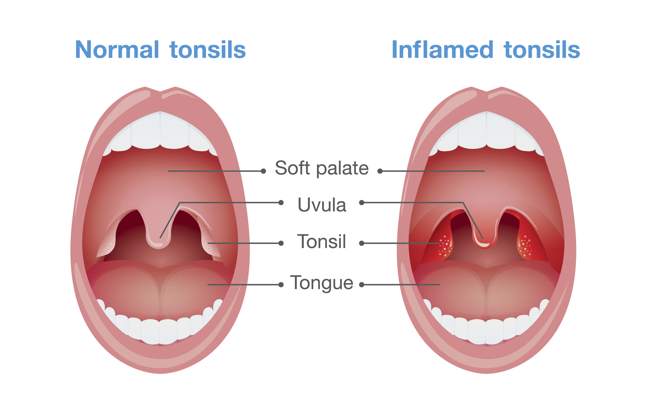 Angina - inflamación de las amígdalas