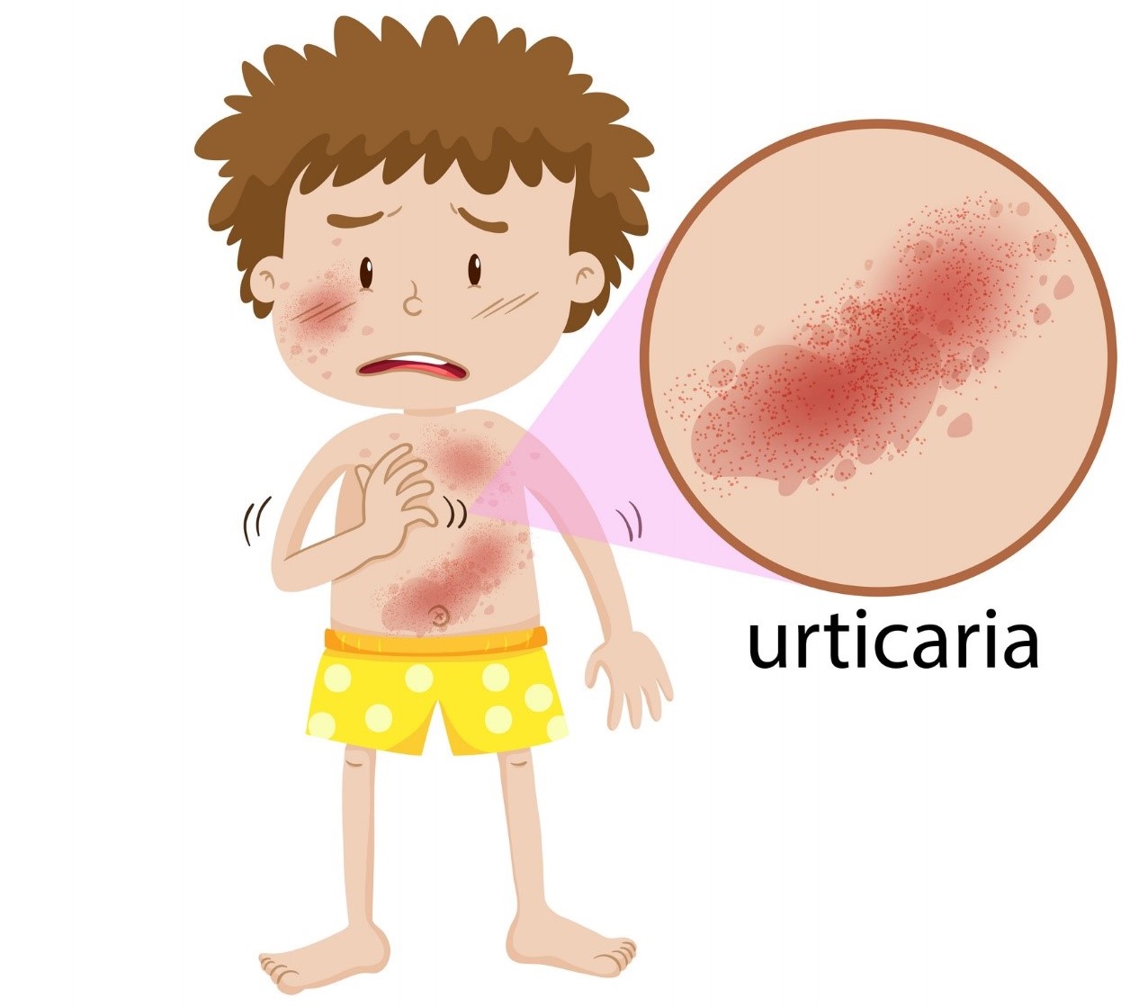 Animación - un niño con erupción en todo el cuerpo, enrojecimiento de la piel, urticaria