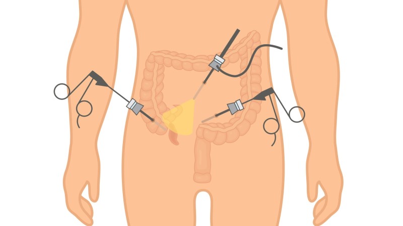 Modelo de representación de la laparoscopia en la apendicitis