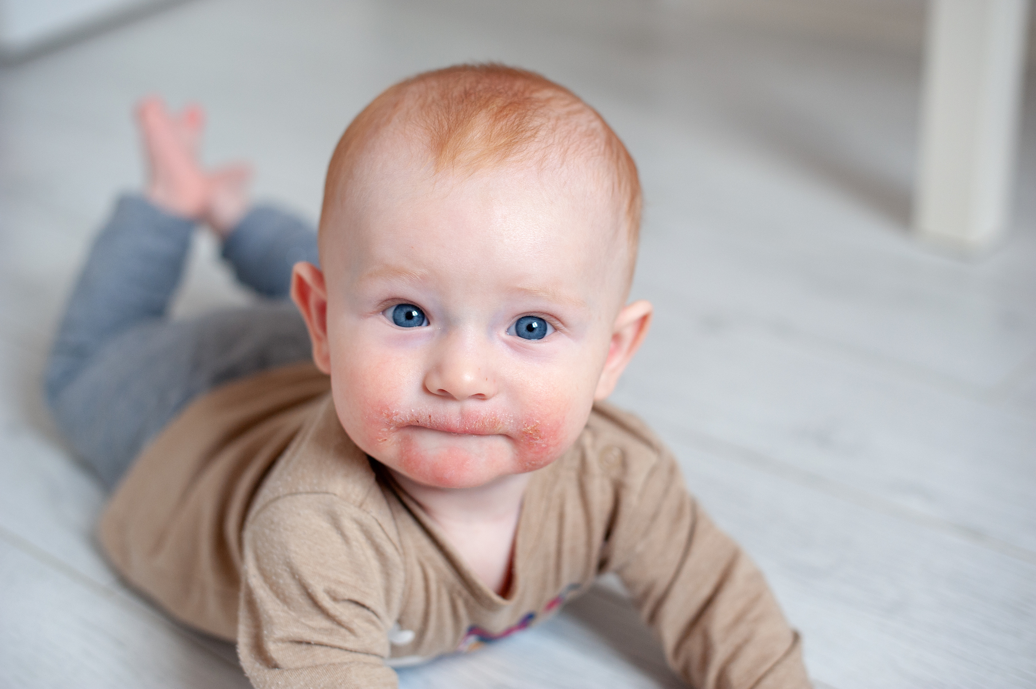 Dermatitis atópica en la cara del niño