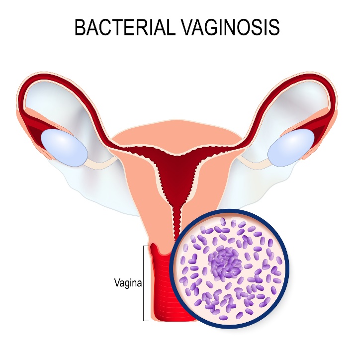 Vaginosis bacteriana y sobrecrecimiento de Gardnerella vaginalis