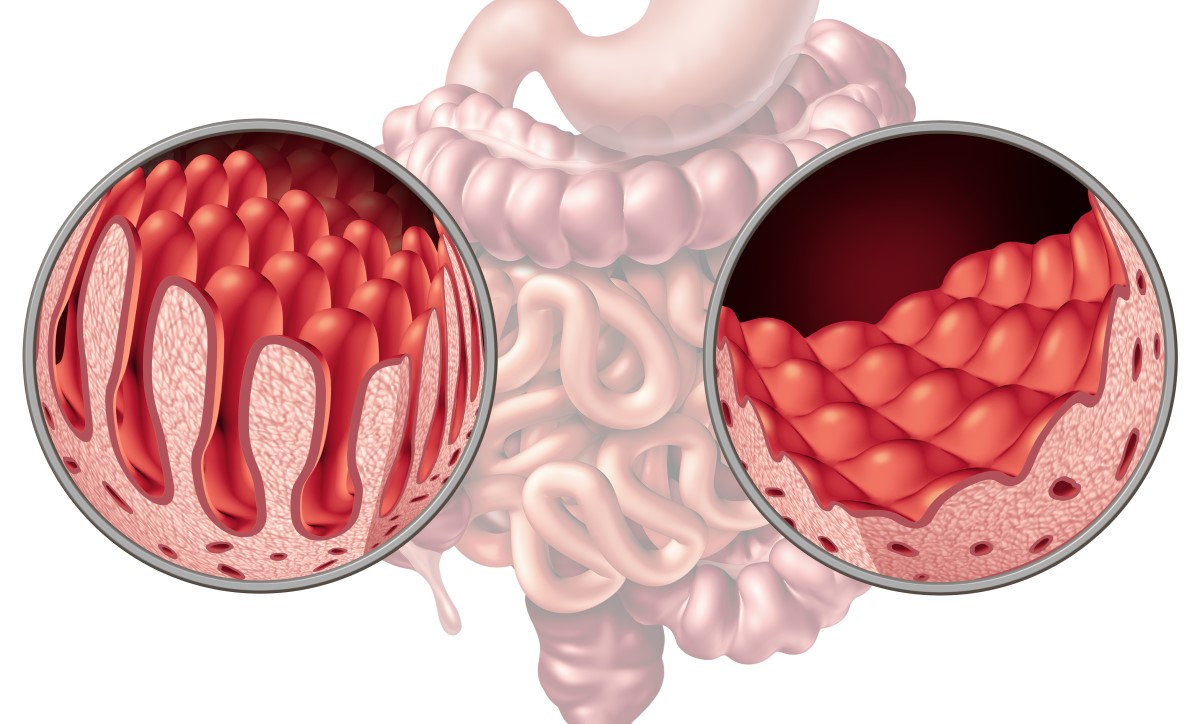 Comparación del intestino y las vellosidades, donde se absorben los nutrientes: sanos y dañados por la celiaquía