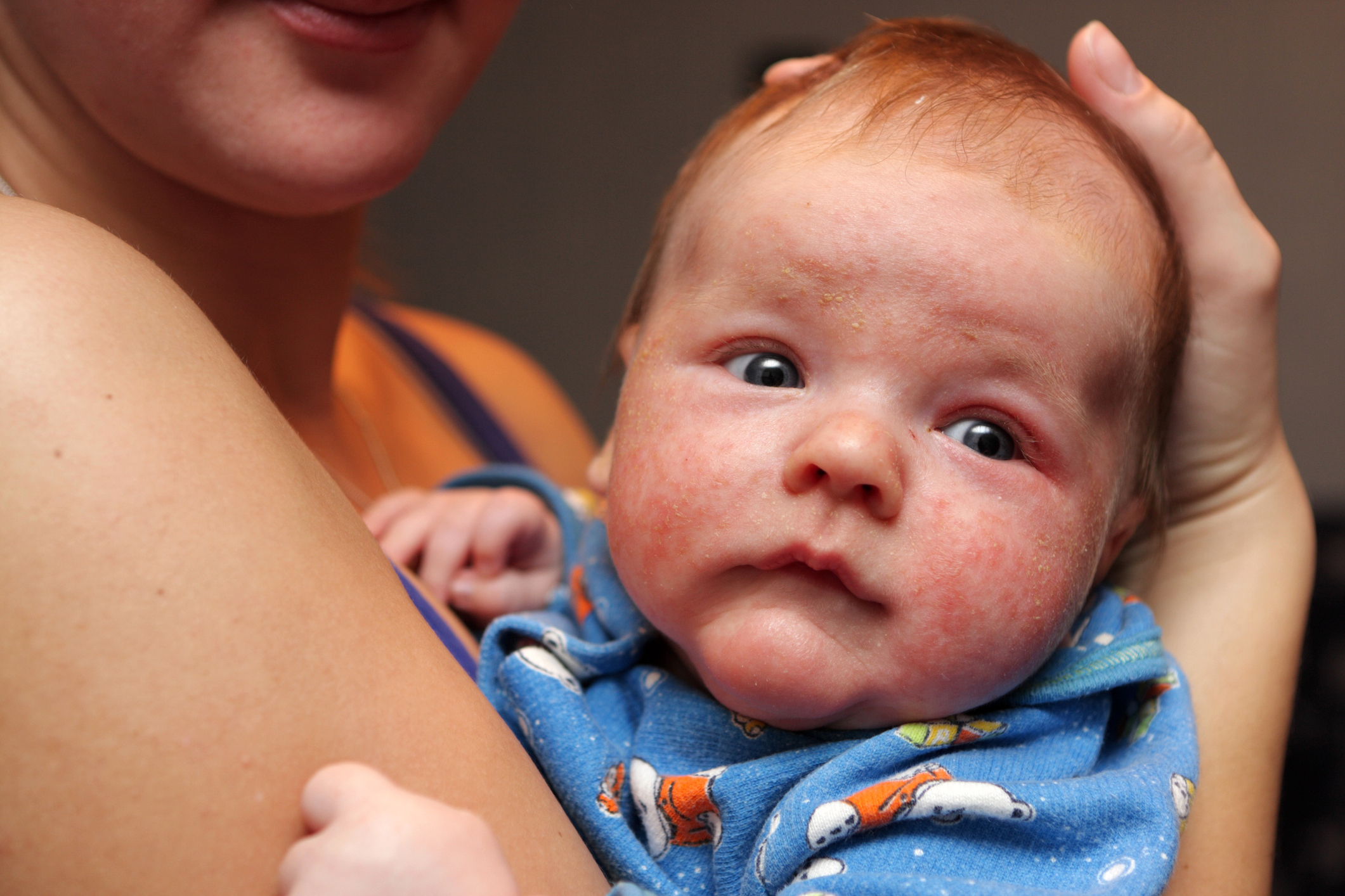 Dermatitis en la cara de un niño pequeño