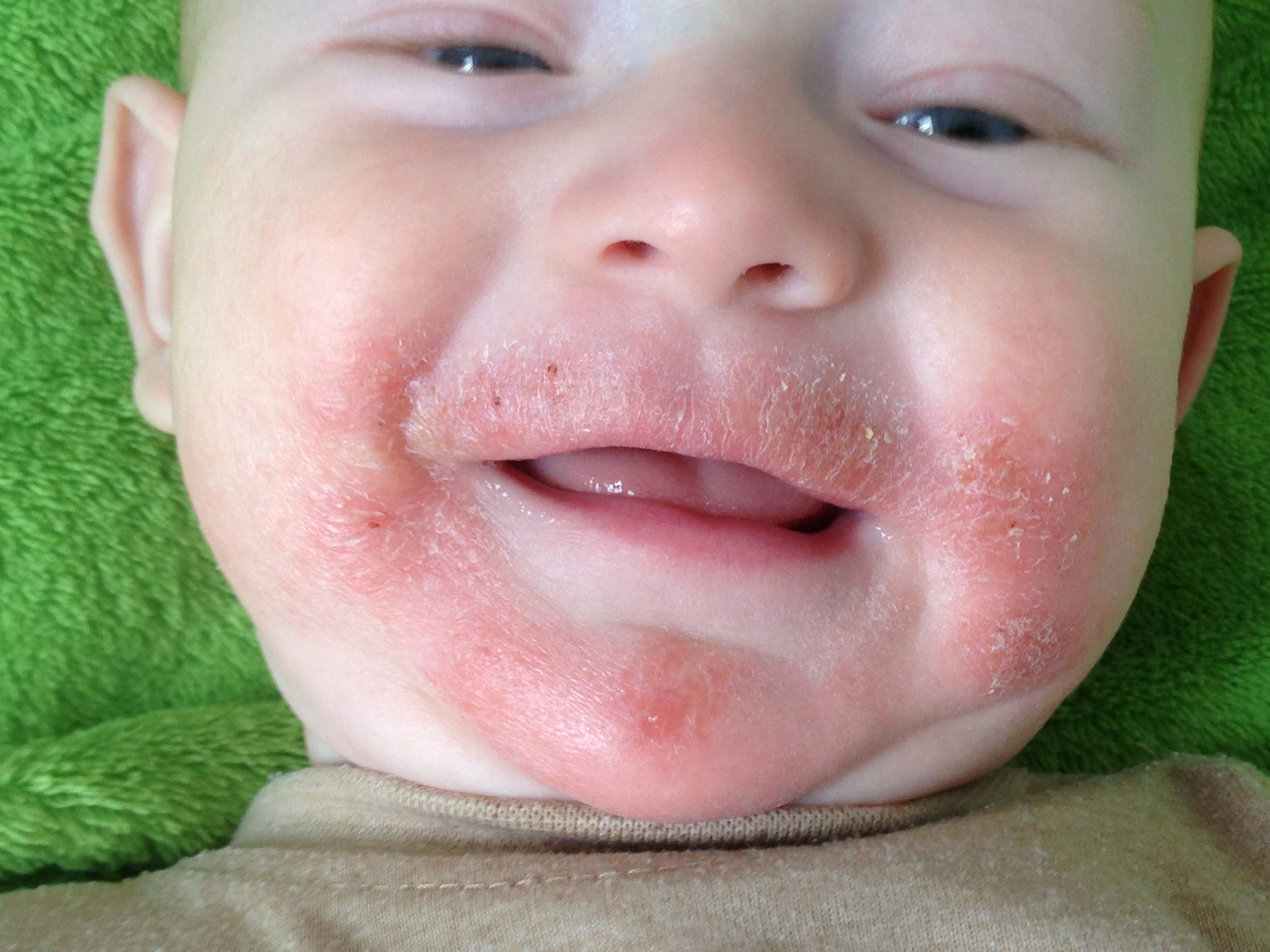 Niño con eczema atópico