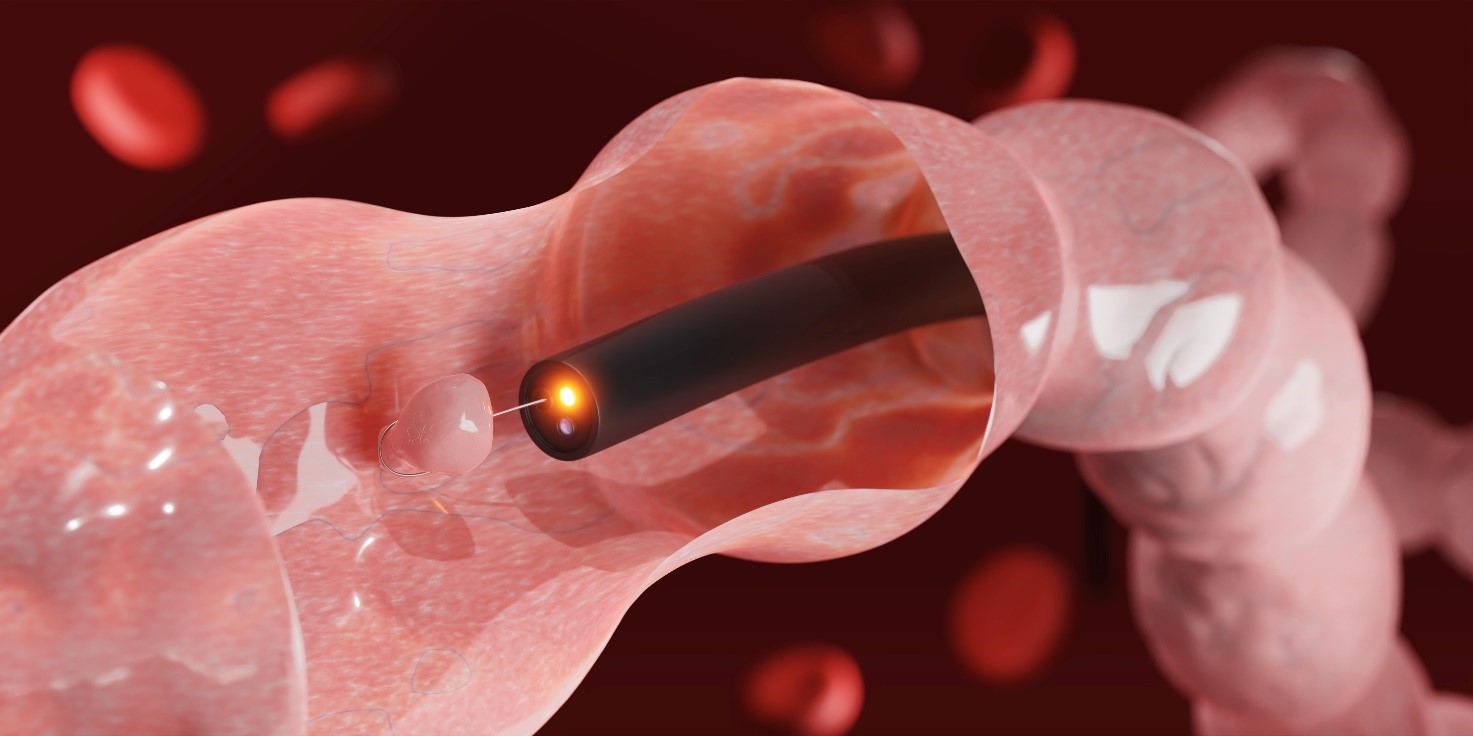 Colonoscopia y biopsia de colon y toma de muestras de pólipos