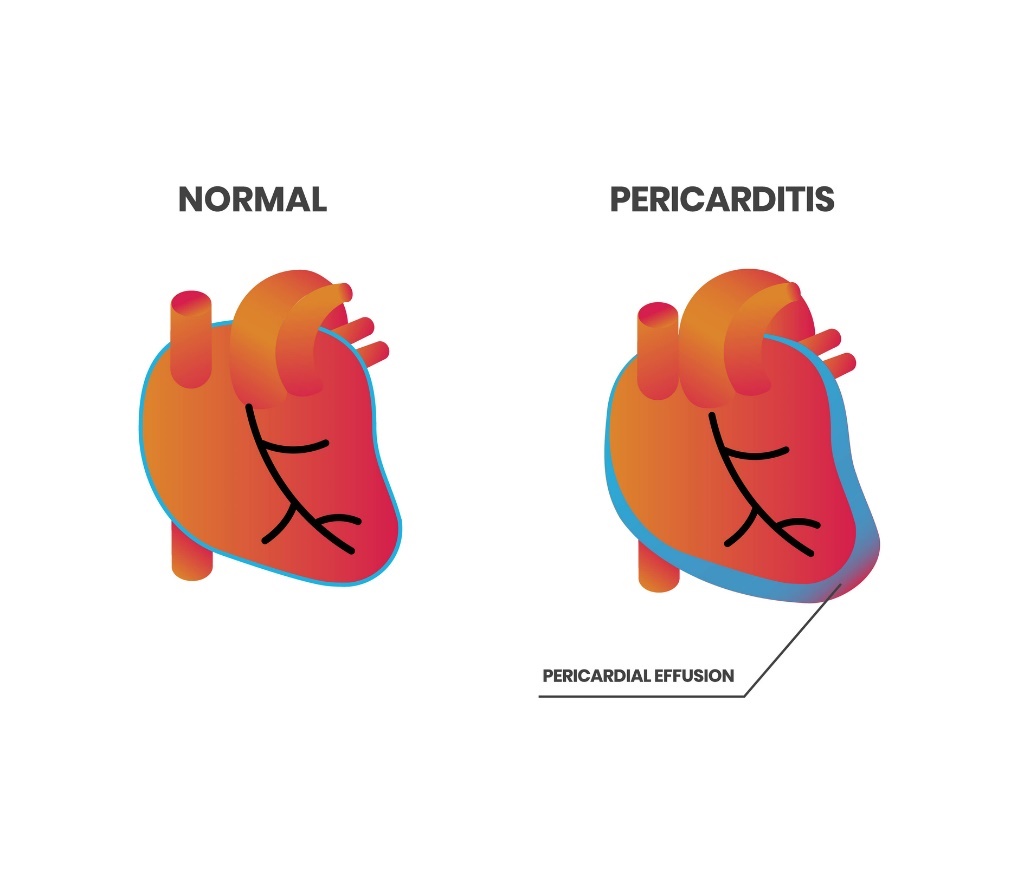 Fisiología cardiaca y pericarditis (derrame pericárdico)