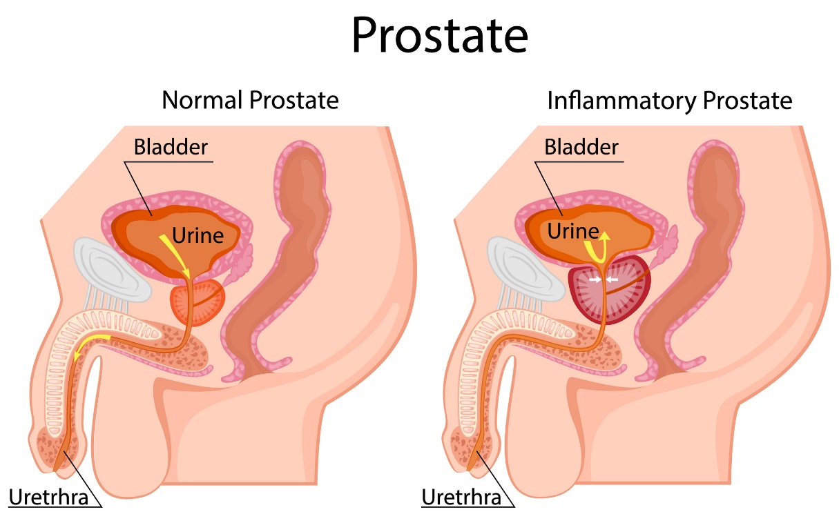 Izquierda: próstata fisiológica. Derecha: próstata agrandada. Situada debajo de la vejiga. Vejiga, orina, uretra.