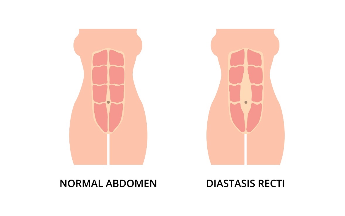 Estado fisiológico de los músculos abdominales y diástasis (separación) de los músculos rectos abdominales izquierdo y derecho desde la línea media de la línea alba.