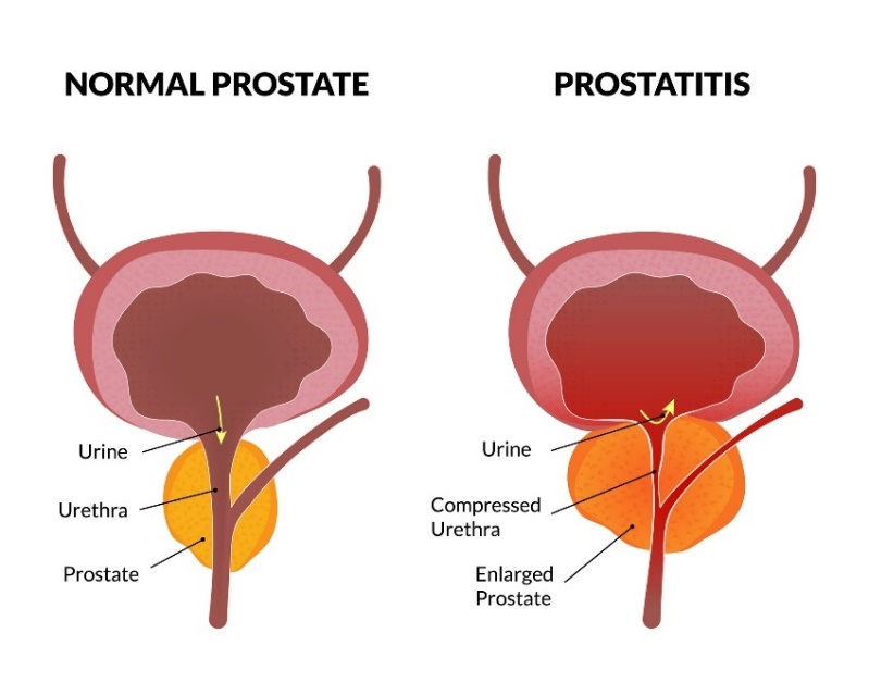 Estado fisiológico de la próstata y prostatitis