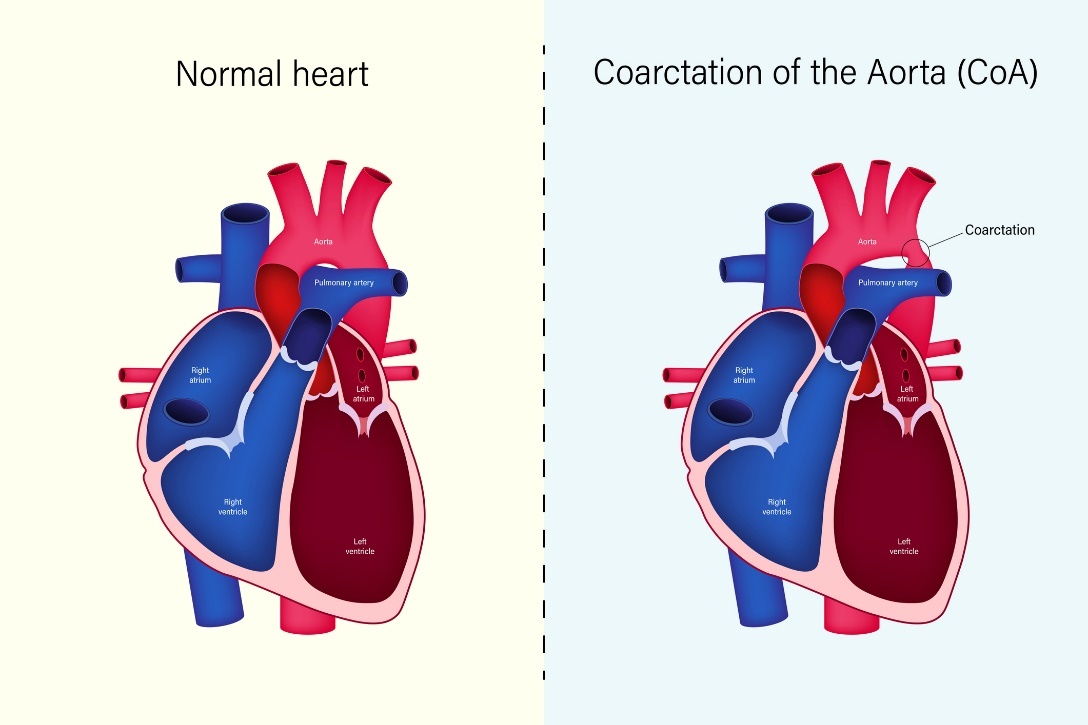 Estado fisiológico del corazón y coartación de aorta (CoA)