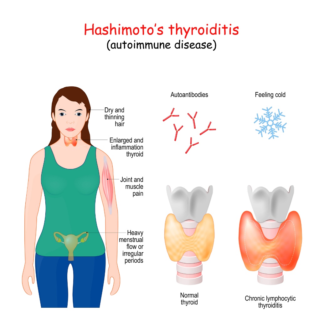 Tiroiditis de Hashimoto y síntomas clínicos