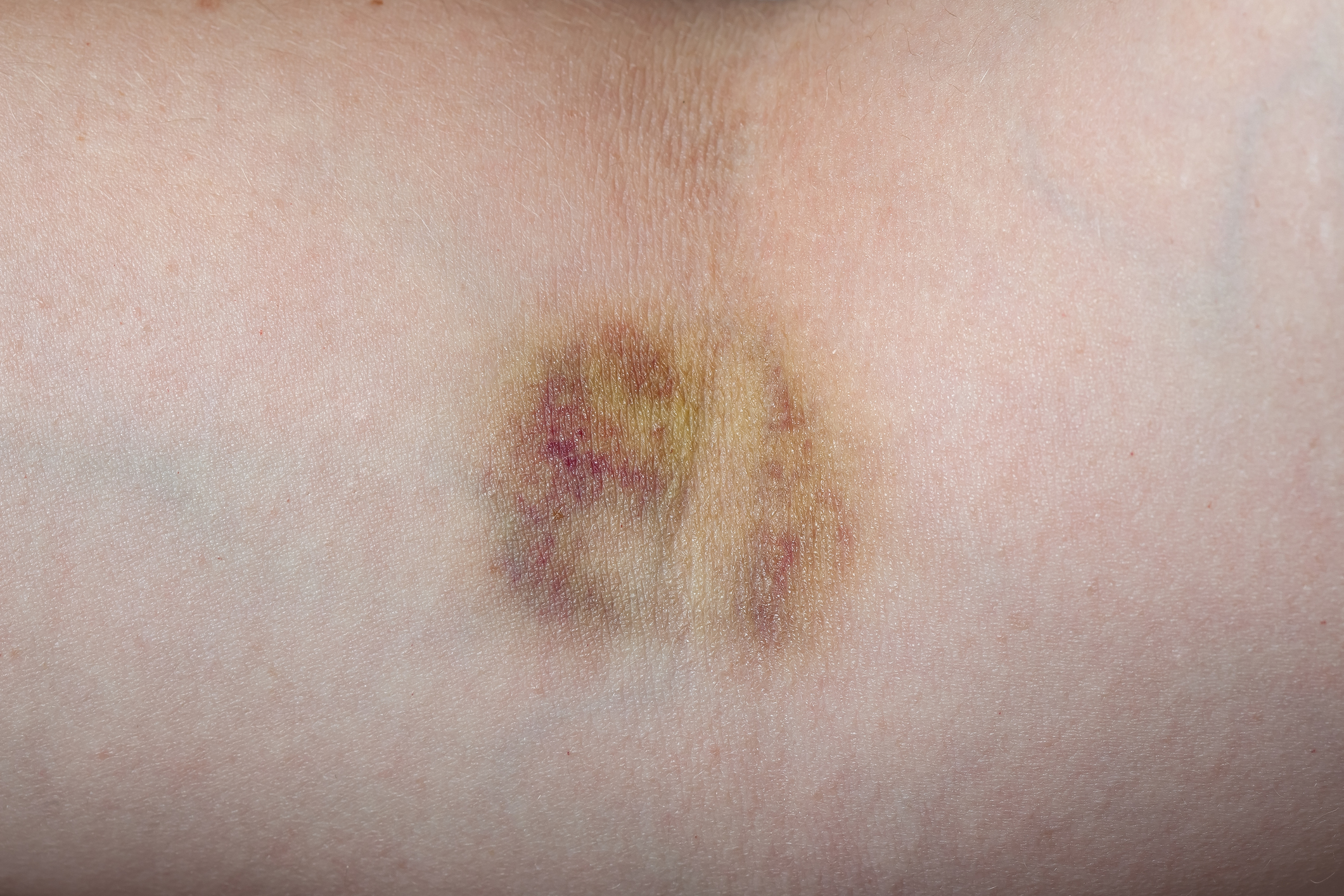 Hematoma (hematoma)