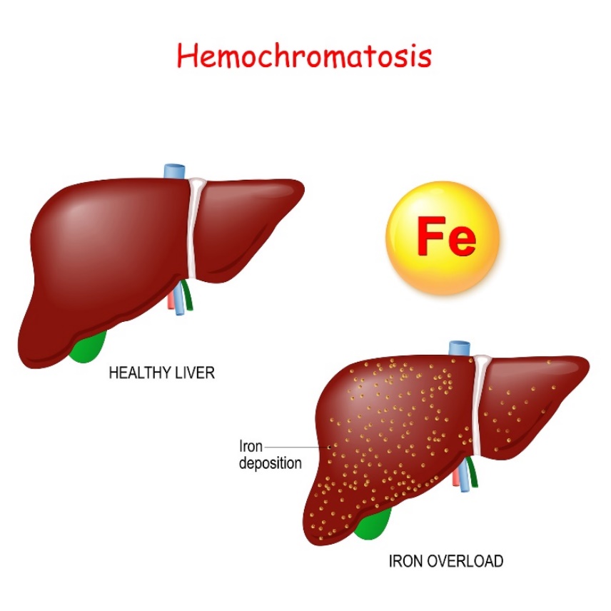 Hemocromatosis: fisiología y patología del hígado con depósito excesivo de hierro (Fe)