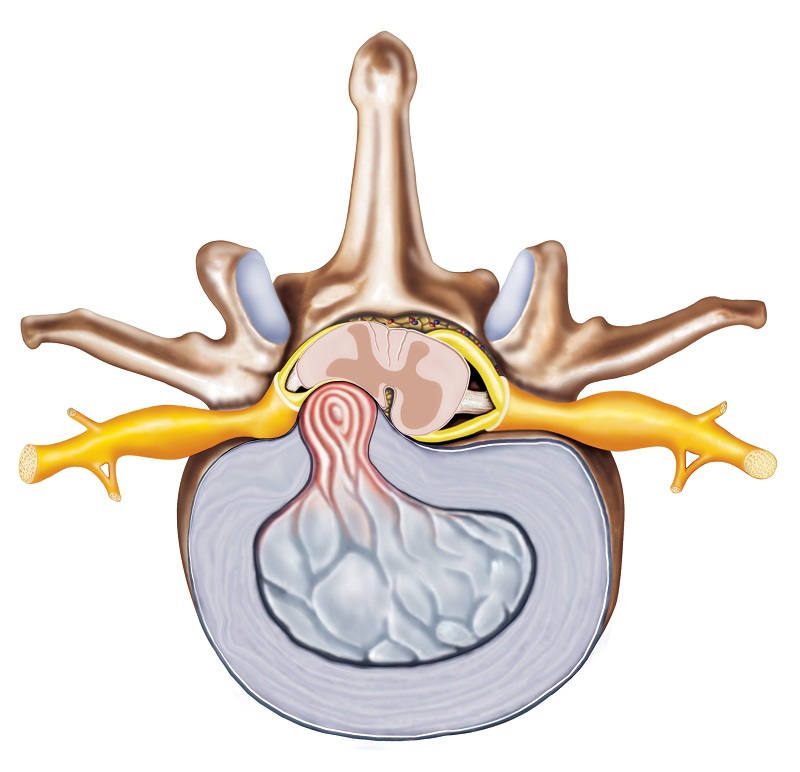 Hernia discal - representación anatómica