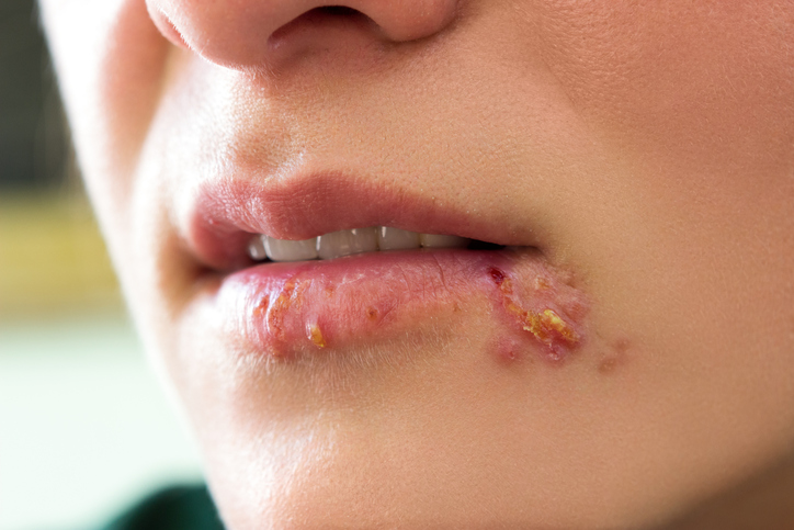 Herpes simple en la cara - labios y comisura de la boca