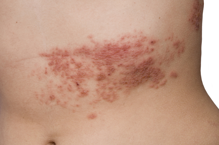 Herpes zóster en el abdomen