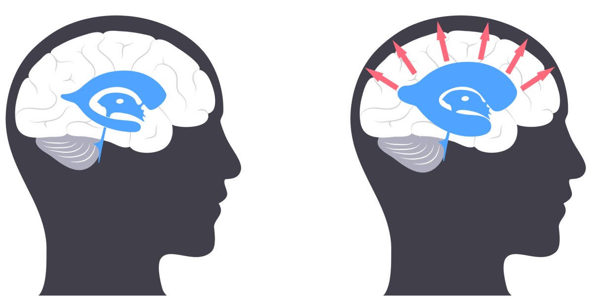 Cabeza con cerebro - a la izquierda - cerebro normal / a la derecha - cabeza con cerebro con hidrocefalia, donde las flechas desde el centro hacia fuera indican el agrandamiento de los ventrículos cerebrales y la presión sobre el tejido cerebral.