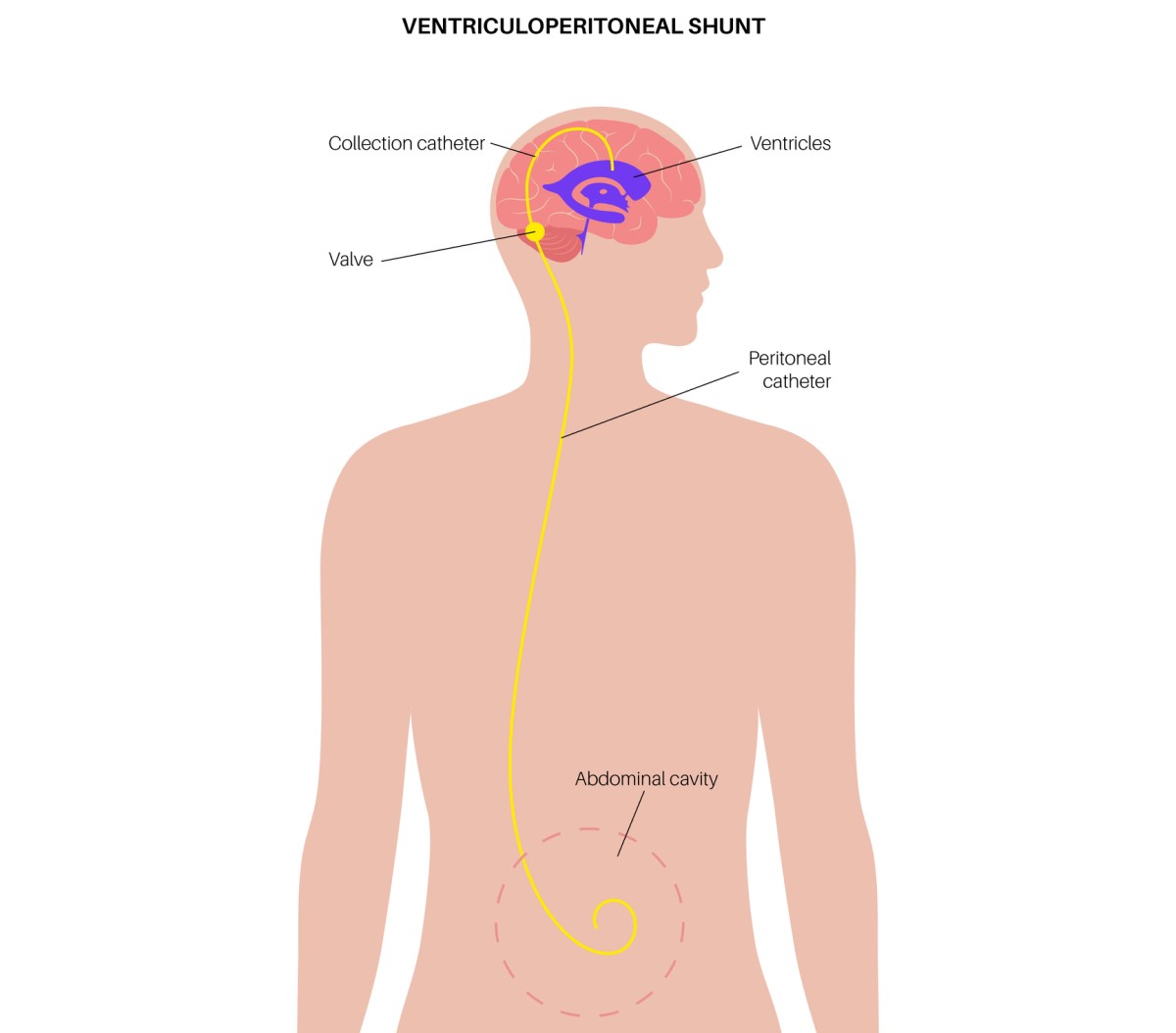 Ilustración de una derivación ventrículo-abdominal que drena el exceso de líquido del cerebro a la cavidad abdominal.