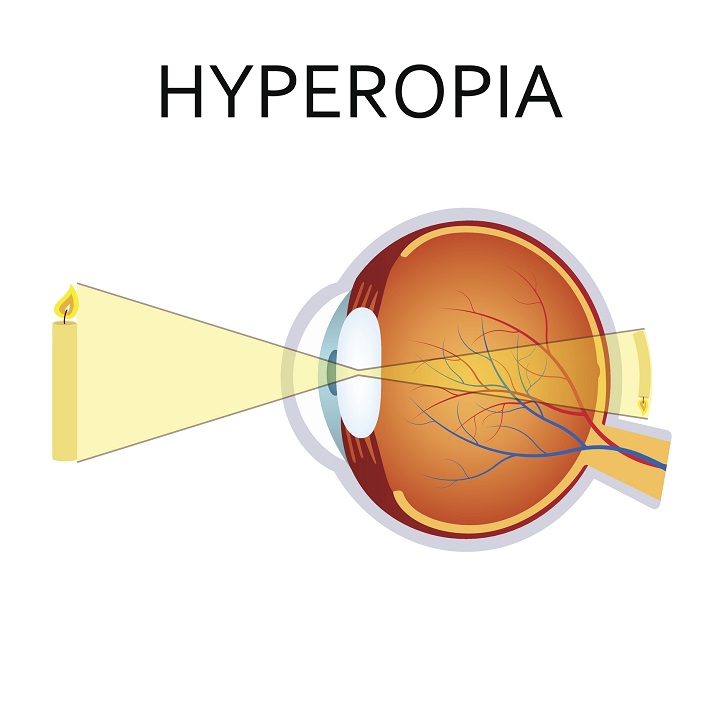 Hipermetropía