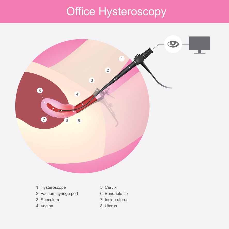 Histeroscopia