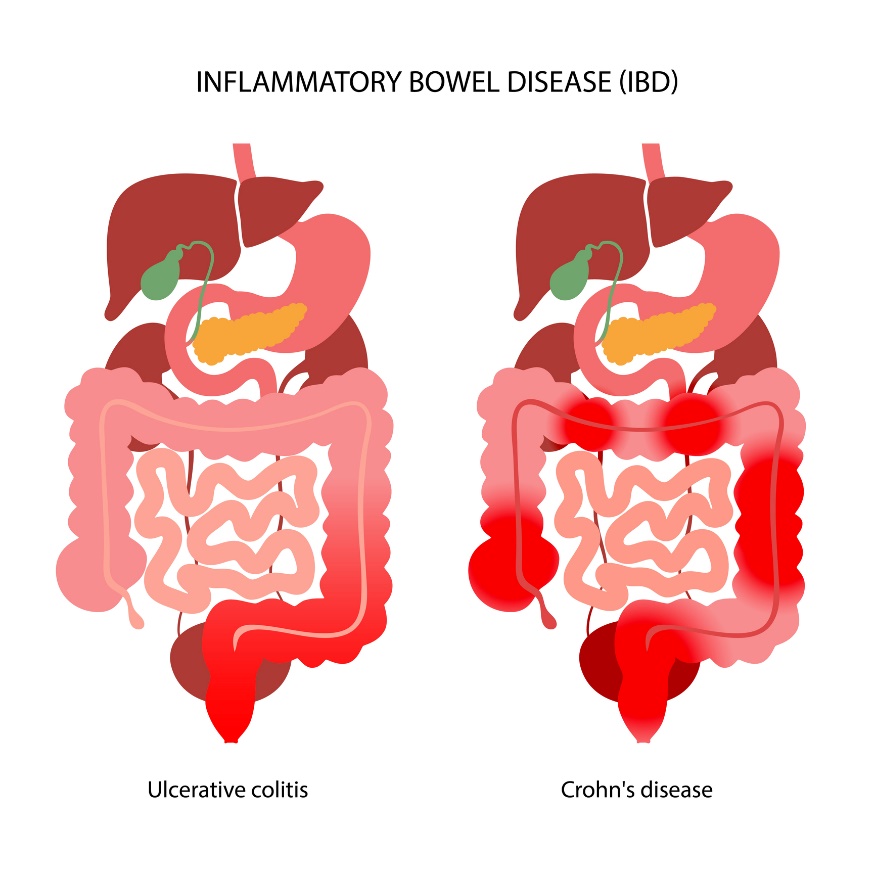 EII: división en colitis ulcerosa y enfermedad de Crohn según la localización de la reacción inflamatoria.