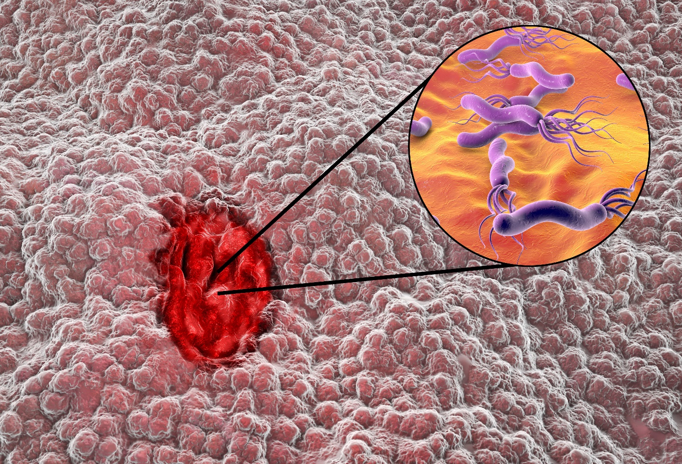 Infección por Helicobacter pylori