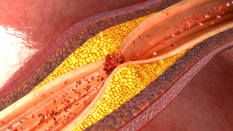 Angina de pecho y aterosclerosis y placa aterosclerótica en el vaso coronario o cardíaco