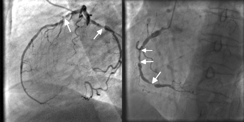 Coronarografía, angiografía, obstrucción arterial coronaria