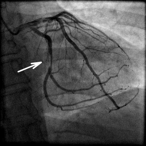 Coronarografía y estrechamiento de la arteria cardiaca