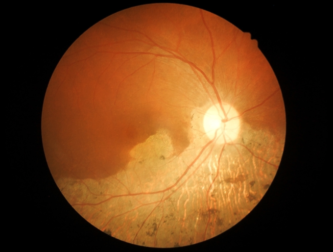 Degeneración macular en el examen oftalmológico