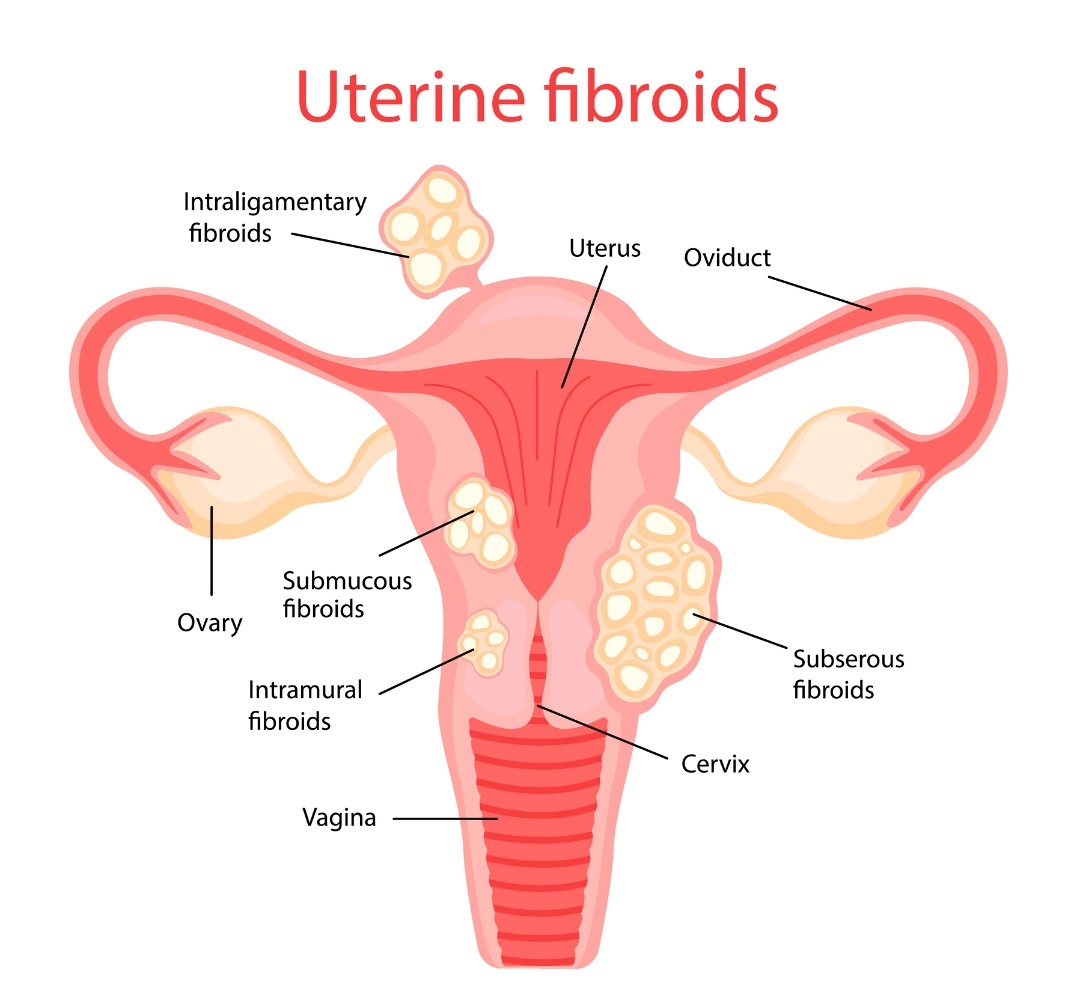 Fibromas uterinos (miomas uterinos)