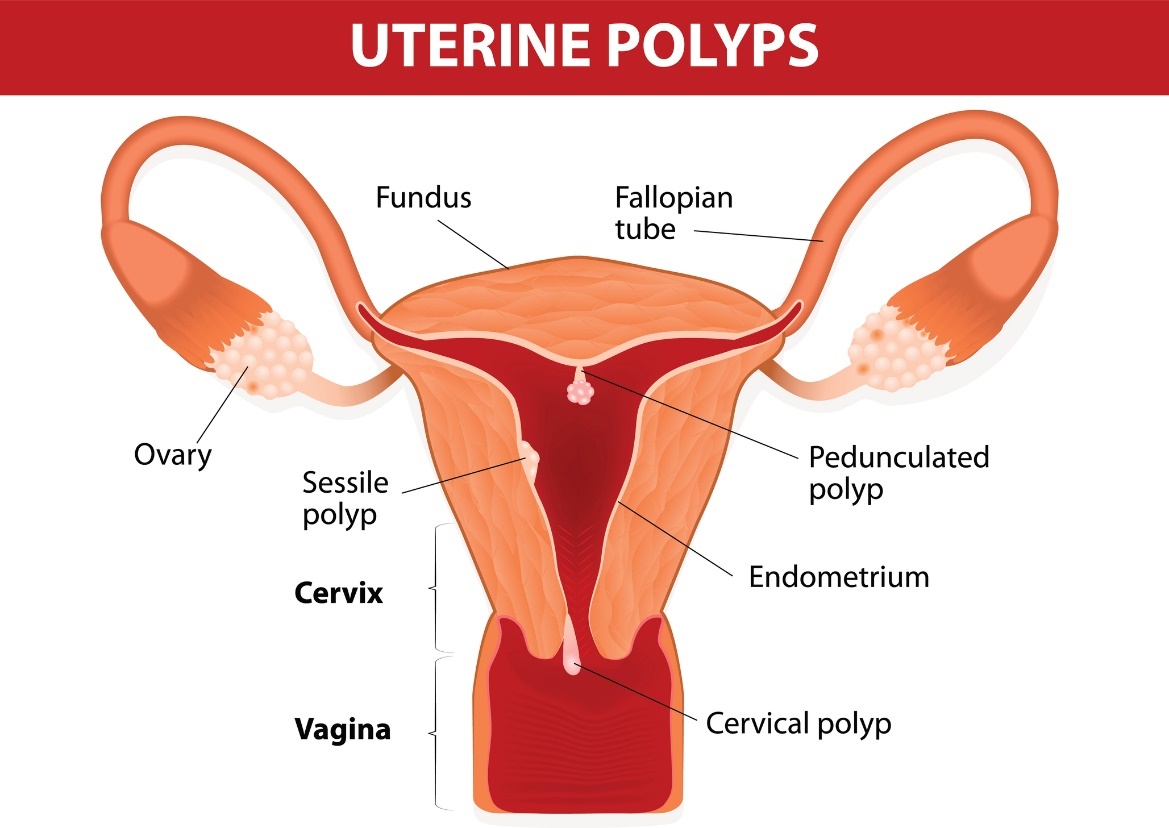 Pólipos uterinos