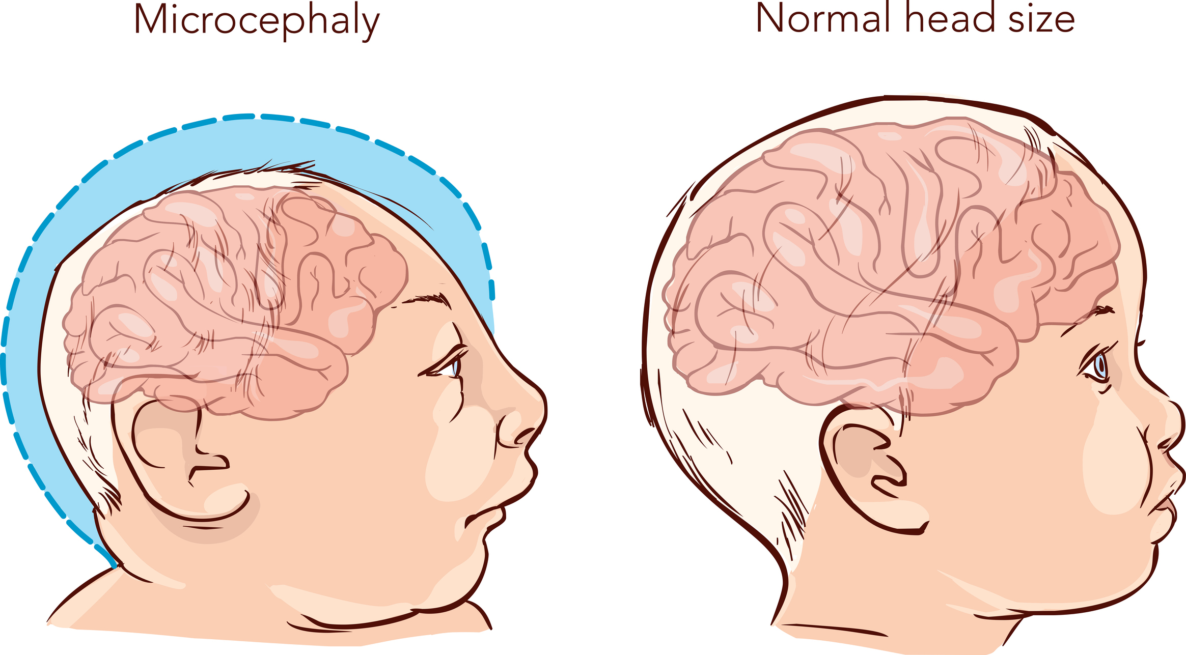 Microcefalia