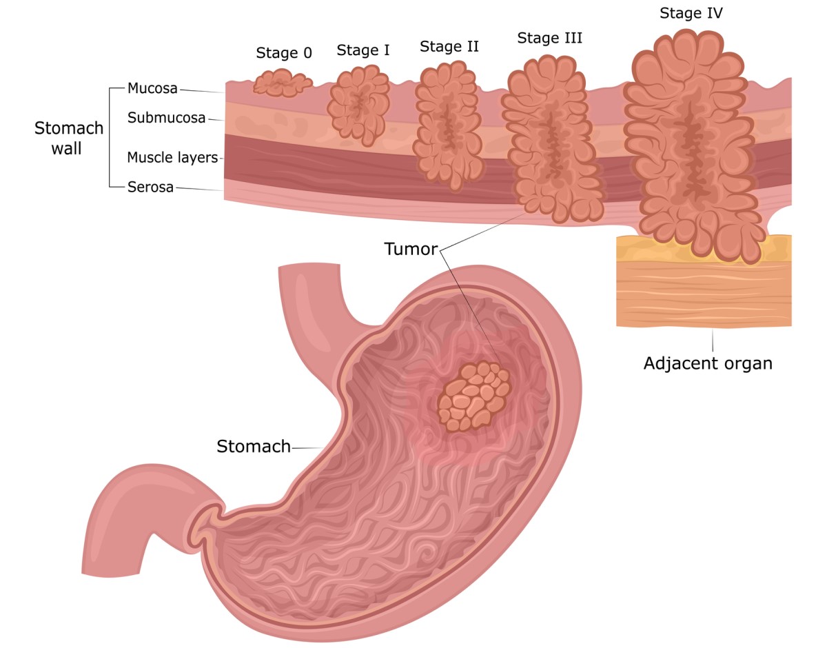 Cáncer gástrico: las capas de la pared del estómago (mucosa, submucosa, músculo, serosa) y las fases de desarrollo del tumor desde la mucosa hasta los alrededores y los órganos.