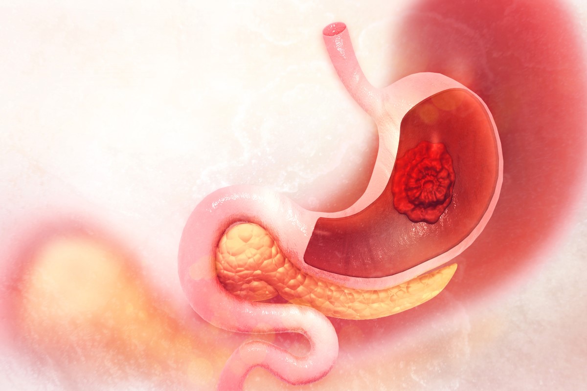 Visualización de un tumor maligno localizado en el estómago.