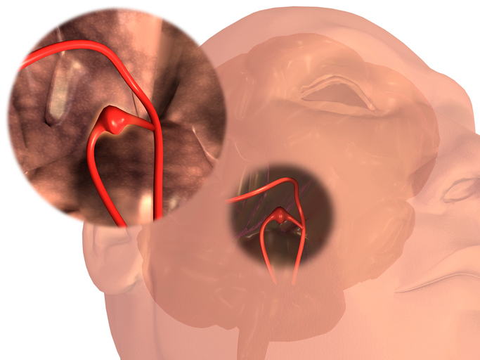 Aneurisma de un vaso sanguíneo cerebral