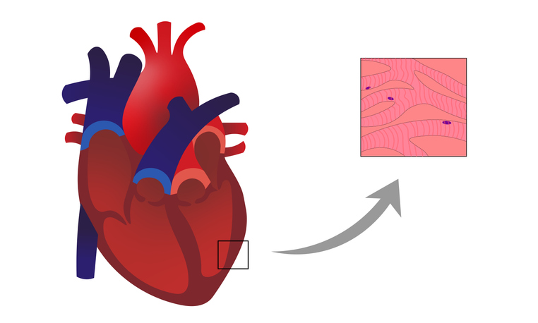 Miocarditis: proceso inflamatorio con infiltrado y degeneración de los cardiomiocitos en la pared del músculo cardíaco.