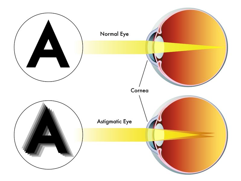 cómo ve una letra un ojo normal en comparación con un ojo astigmático