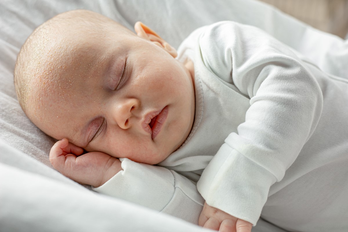 Un niño pequeño, recién nacido, durmiendo, con seborrea y escamas en la cabeza.