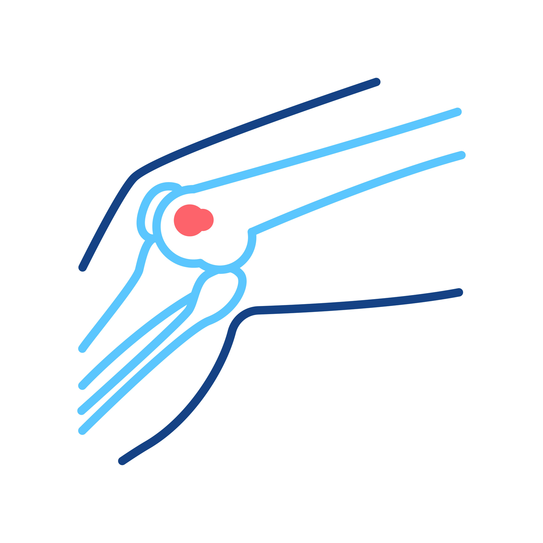 Osteosarcoma de rodilla