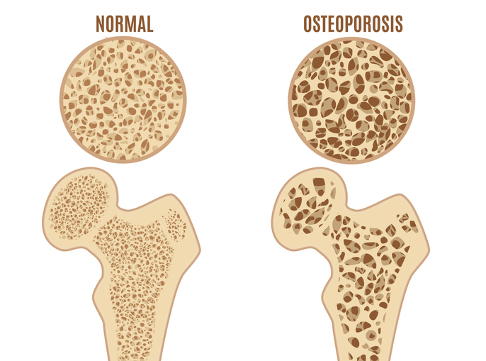 Osteoporosis del fémur