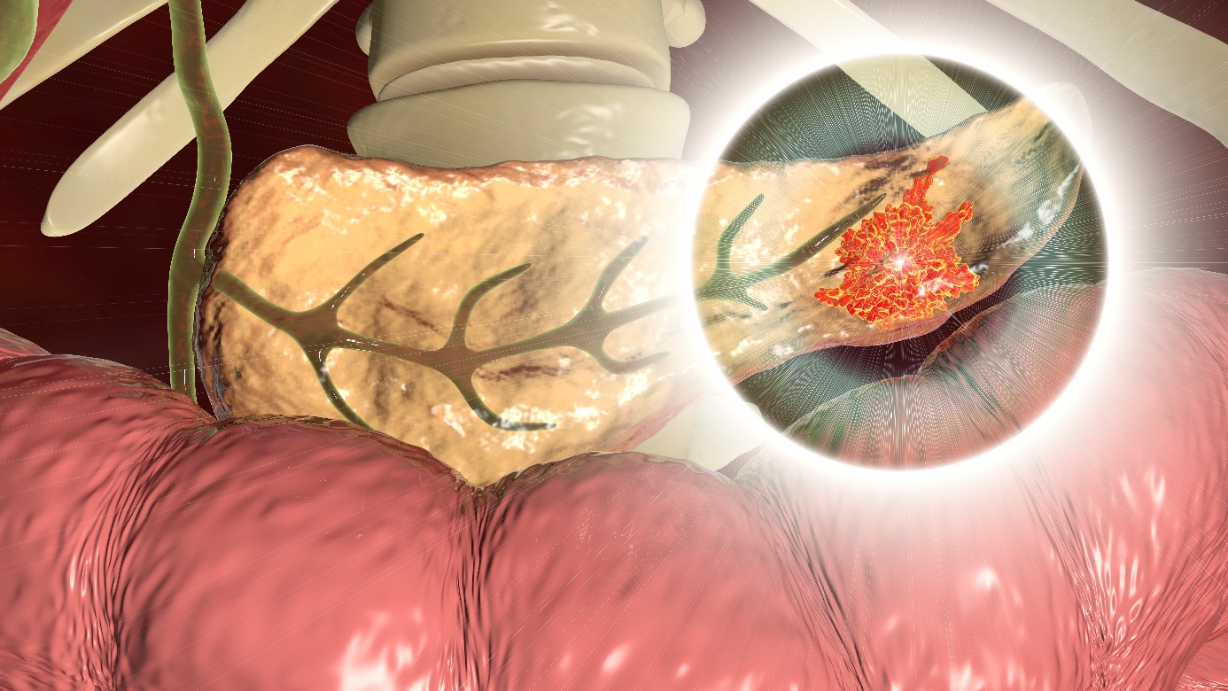 Pancreatitis - parte infectada del páncreas - cola del páncreas, vista anatómica