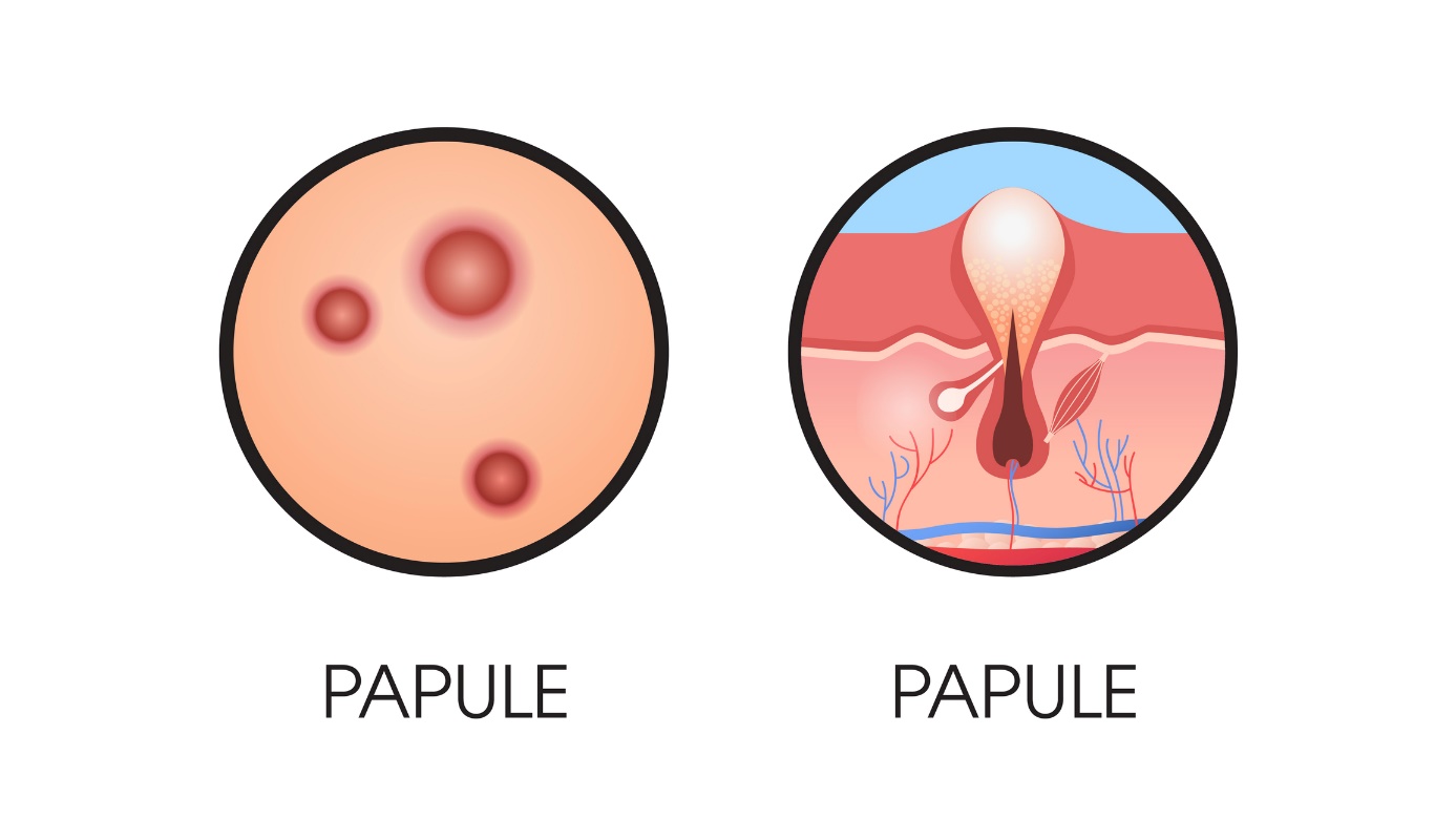 pápula en la piel